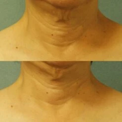 Perricone MD Cold Plasma Plus Neck And Chest 30ml -Cheap Dewloria Store 12243916 1865010976255062